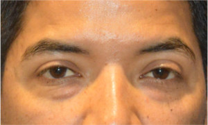 Blepharoplasty