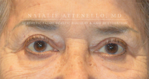 Blepharoplasty