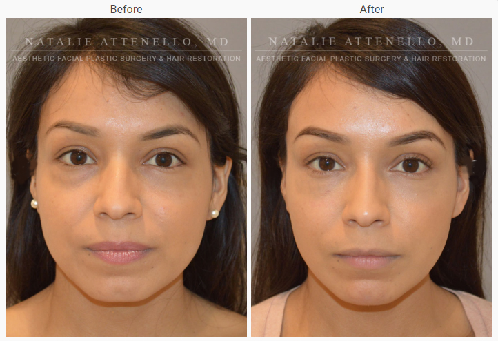 Facial Plastic Surgery Beverly Hills